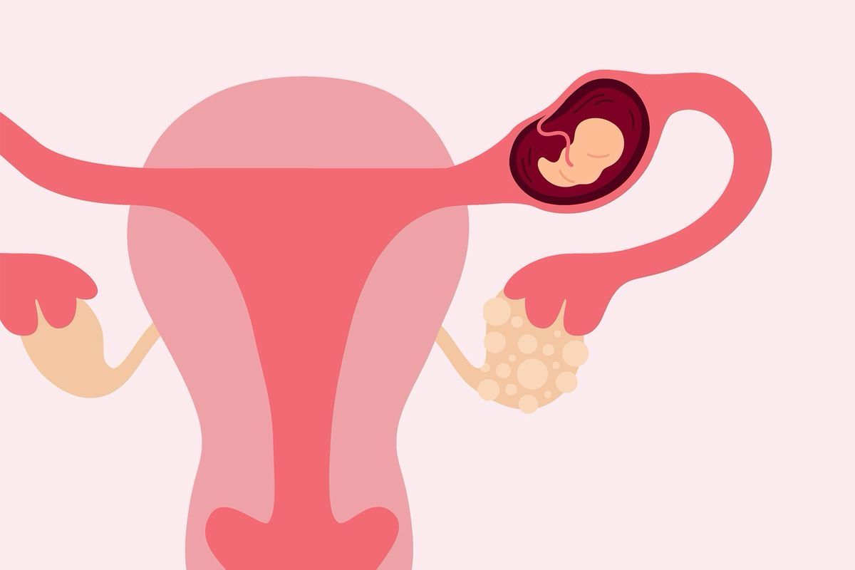 الحمل خارج الرحم: الخطر الصامت الذي يهدد حياة المرأة